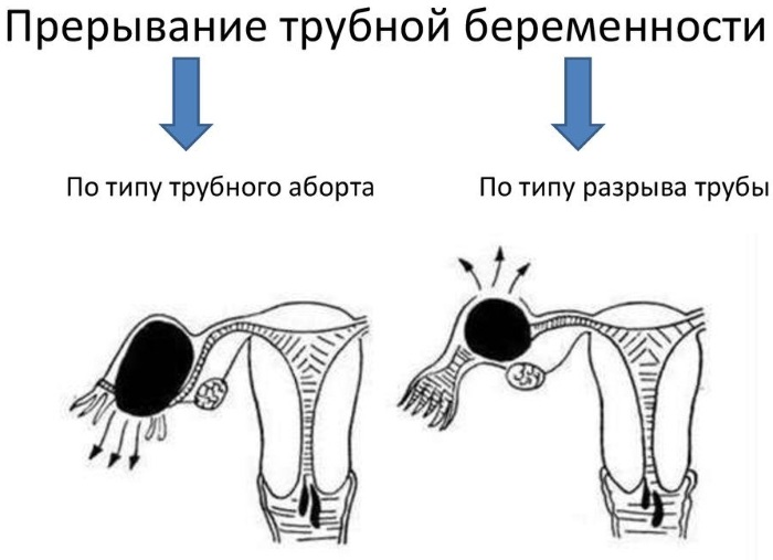 Неотложные состояния в гинекологии. Какие это, первая помощь, клинические рекомендации