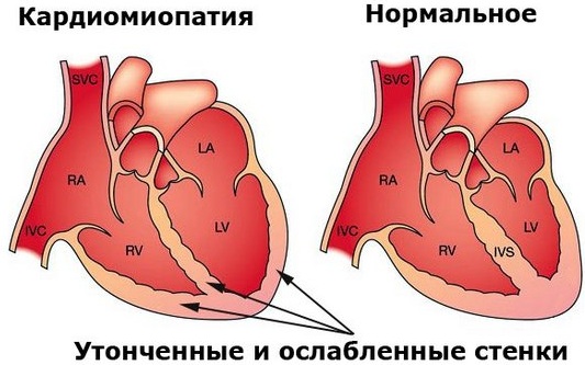 Одышка в покое. Причины у пожилых, молодых людей, лечение