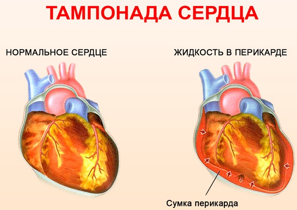 Синдром Дресслера при инфаркте миокарда. Лечение