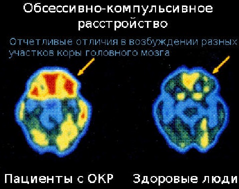 ОКР (это обсессивно-компульсивное расстройство) психическое заболевание. Симптомы и лечение, причины