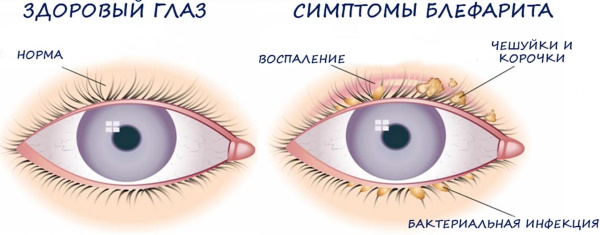 Опухшие глаза утром. Причины верхнее, нижнее веко, как убрать, избавиться от отеков