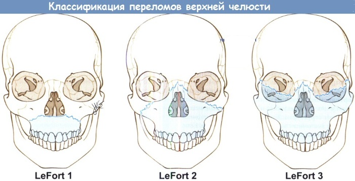 Перелом верхней челюсти. Лечение, первая помощь, симптомы, открытый, закрытый