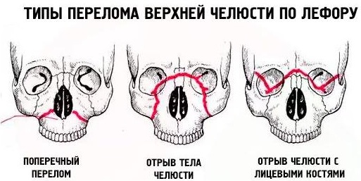 Перелом верхней челюсти. Лечение, первая помощь, симптомы, открытый, закрытый