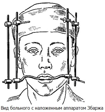 Перелом верхней челюсти. Лечение, первая помощь, симптомы, открытый, закрытый