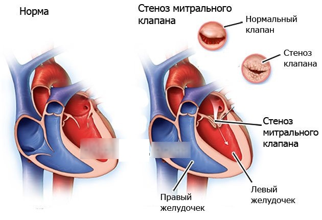 Поперечник сердца у детей. Норма, чему равен при недостаточности аортального клапана, гипертрофии желудочка, стенозе