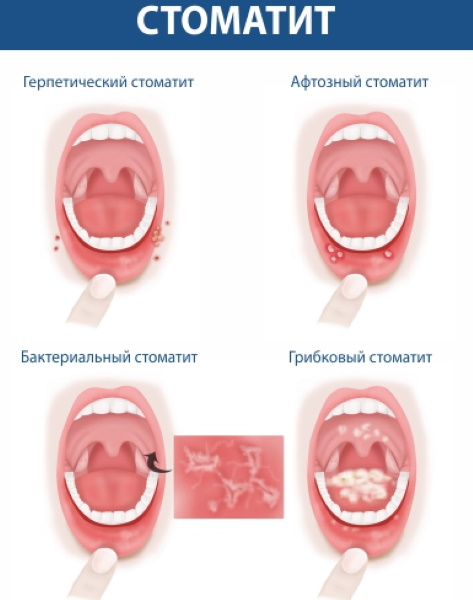 Ротокан (Rotocanum) для полоскания десен при воспалении. Как разводить, применение, цена, отзывы