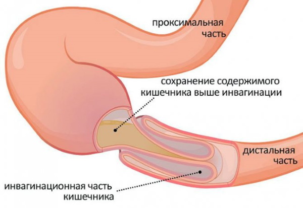 Промывание желудка через зонд у детей, взрослых. Алгоритм, техника, противопоказания