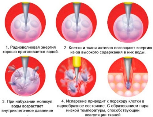 Гемангиома на лице. Фото, что это такое у ребенка, взрослых, причины, лечение