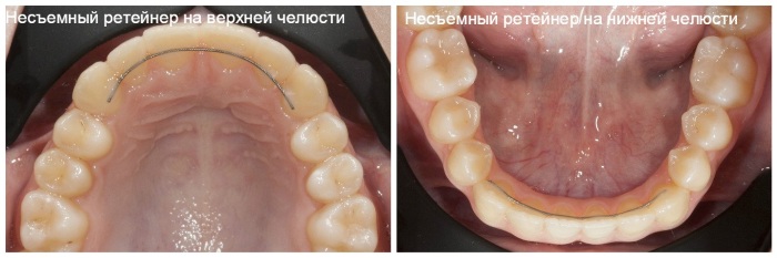 Ретейнеры после брекетов. Фото, из чего делают, установка, как носить