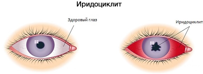 Циклопентолат глазные капли. Инструкция по применению, цена, отзывы