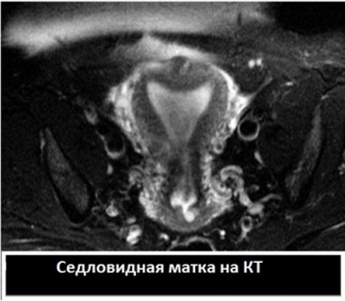 Седловидная матка. Что это такое, что значит при беременности, лечение