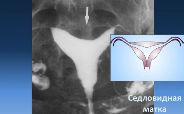 Седловидная матка. Что это такое, что значит при беременности, лечение