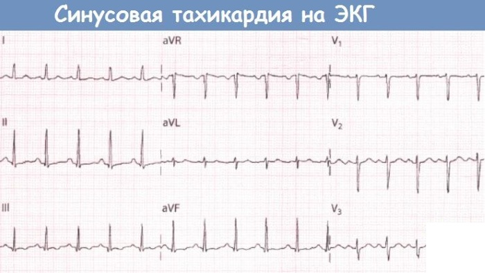 Синусовая тахикардия сердца. Что это такое, симптомы, как лечить у женщин, детей