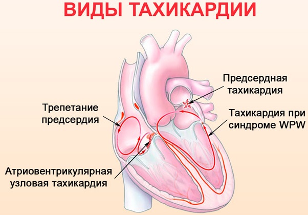 Синусовая тахикардия сердца. Что это такое, симптомы, как лечить у женщин, детей