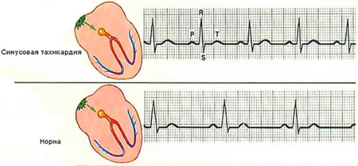 Синусовая тахикардия сердца. Что это такое, симптомы, как лечить у женщин, детей