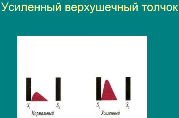 Верхушечный толчок. Норма у детей, при гипертонической болезни, гипертрофии желудочка, ИБС