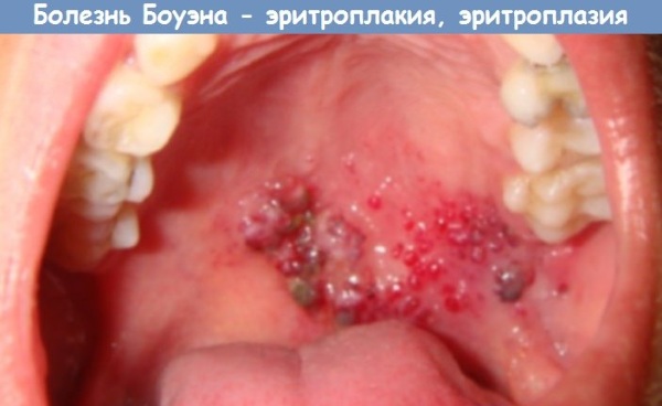 Заболевания слизистой оболочки полости рта. Классификация, профилактика, лечение