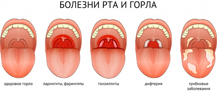 Заболевания слизистой оболочки полости рта. Классификация, профилактика, лечение