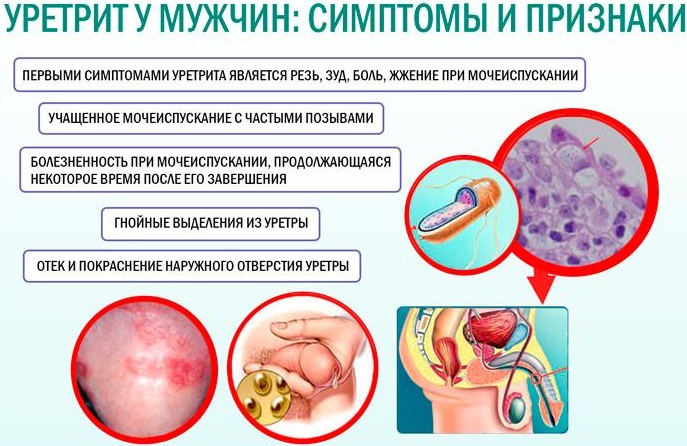 Жжение в уретре в головке у мужчин с выделениями и без. Причины и лечение