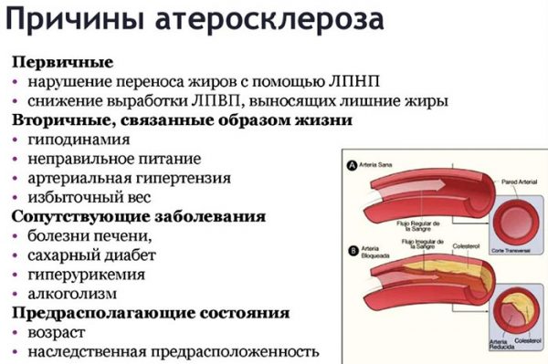 Атеросклероз сосудов сердца. Симптомы и лечение у пожилых людей, причины