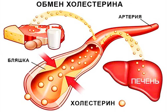 Атеросклероз сосудов сердца. Симптомы и лечение у пожилых людей, причины