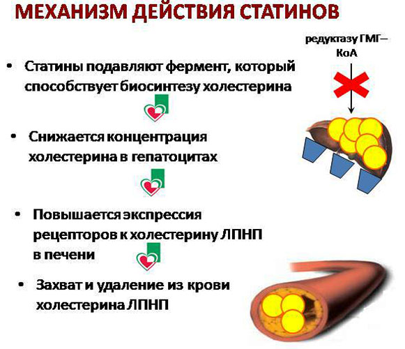 Атеросклероз сосудов сердца. Симптомы и лечение у пожилых людей, причины