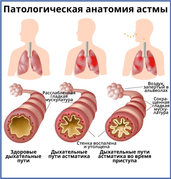 Атопическая бронхиальная астма. Что это такое, клинические рекомендации, лечение