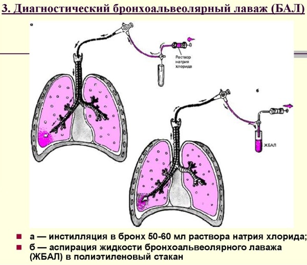 Атопическая бронхиальная астма. Что это такое, клинические рекомендации, лечение