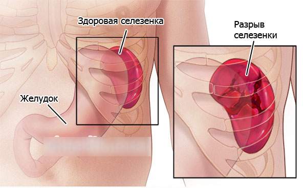 Боль в селезенке. Симптомы при ходьбе, беге, вдохе. Причины и лечение