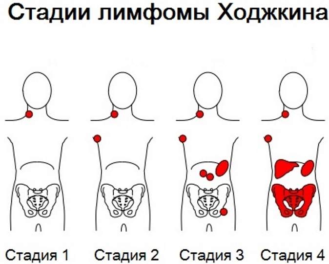 Болезнь Ходжкина (нодулярный склероз). Что это, анализ, патогенез, клинические рекомендации