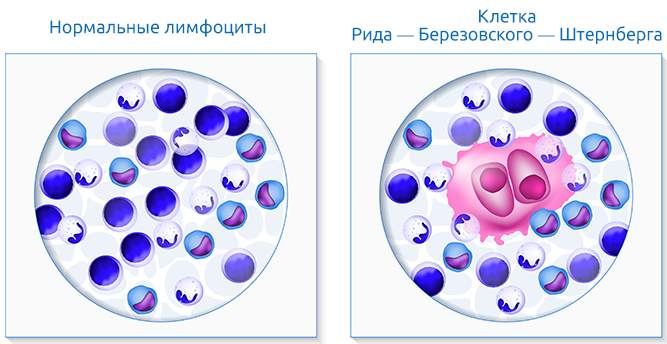 Болезнь Ходжкина (нодулярный склероз). Что это, анализ, патогенез, клинические рекомендации