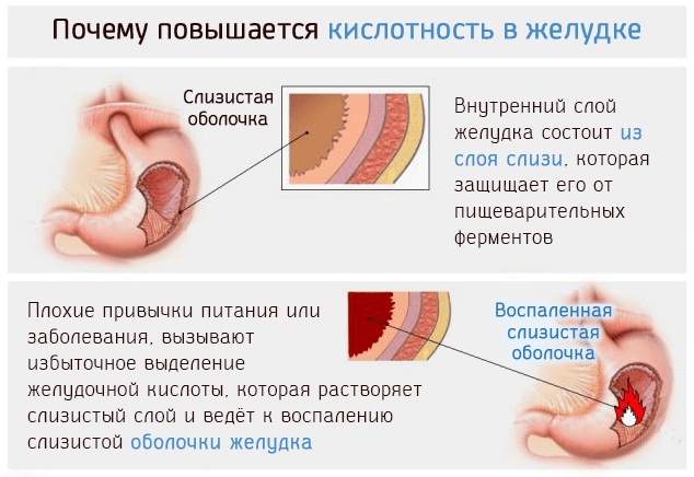 Боли при гастрите желудка. Симптомы, где болит, чем снять, лечение