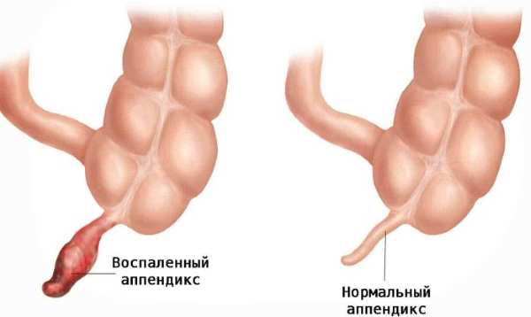 Твердый живот. Причины у женщин, мужчин в районе пупка, что делать