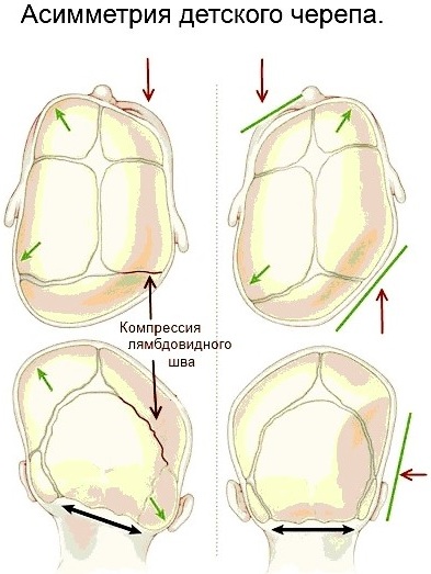 Деформация черепа у новорожденных, ребенка, при тазовом предлежании. Признаки, симптомы, как исправить