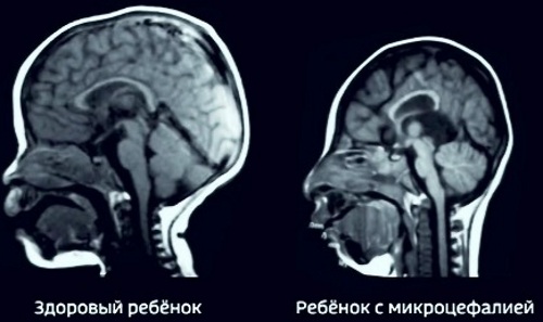 Деформация черепа у новорожденных, ребенка, при тазовом предлежании. Признаки, симптомы, как исправить