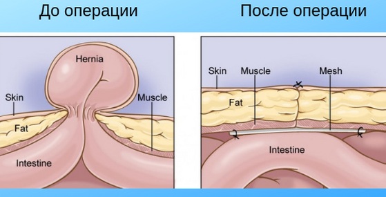 Дифференциальная диагностика пупочной грыжи. Таблица, фото у взрослых, детей