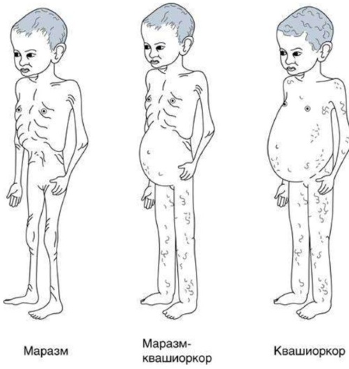 Гипотрофия. Что это за расстройство питания, лечение, клинические рекомендации, степени