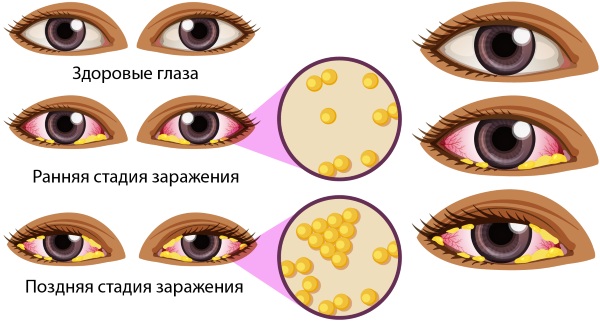 Глазные капли для новорожденных от нагноения. Цены, отзывы