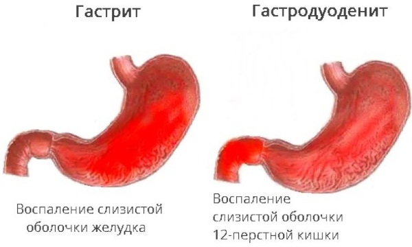 Хлориды в крови. Норма, что значит понижены, повышены у женщин, детей, беременных