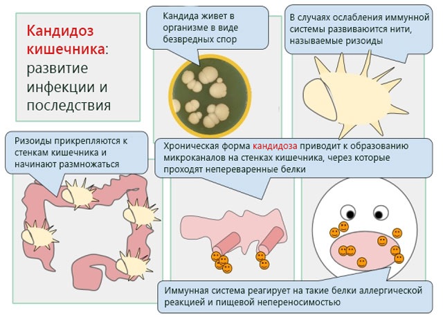 Как избавиться от кандиды в организме навсегда. Народные средства, лекарства