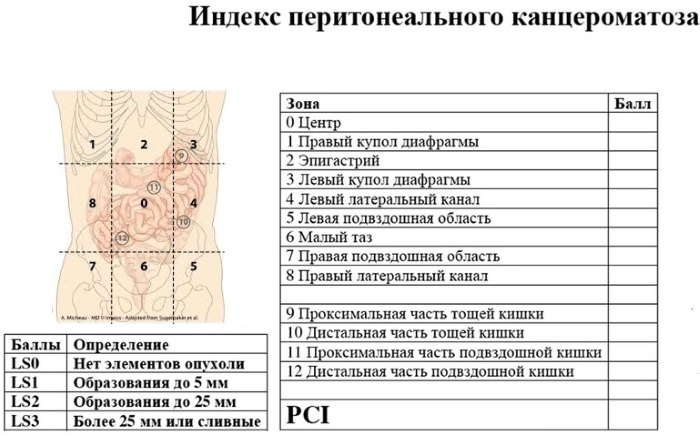 Канцероматоз брюшной полости. Лечение, что это такое, симптомы, прогноз