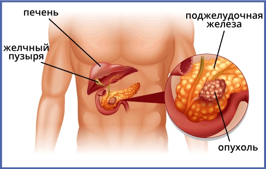 Канцероматоз брюшной полости. Лечение, что это такое, симптомы, прогноз