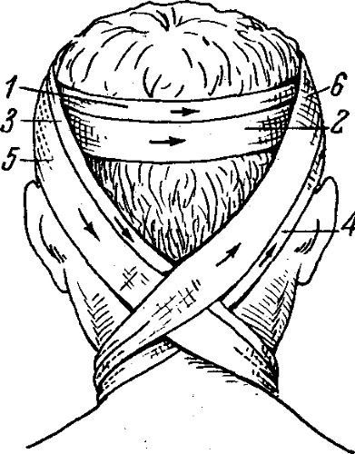 Крестообразная повязка на затылок, шею. Алгоритм, показания, фото