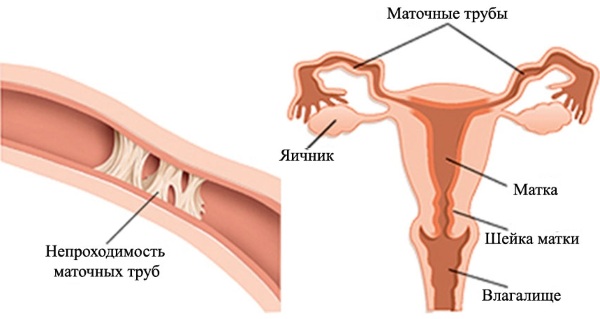 Непроходимость маточных труб. Что это такое, причины, признаки, лечение