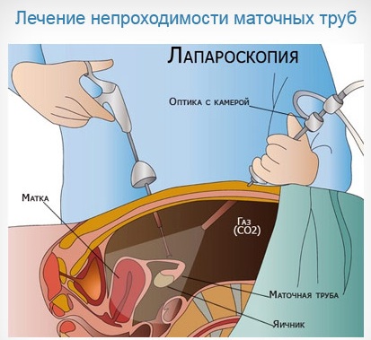 Непроходимость маточных труб. Что это такое, причины, признаки, лечение