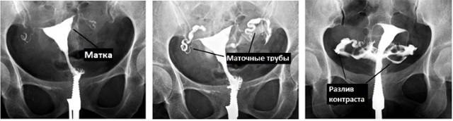 Непроходимость маточных труб. Что это такое, причины, признаки, лечение