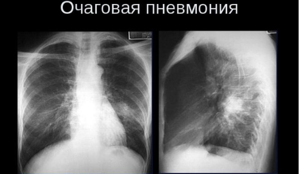 Очаговая пневмония у детей, взрослых. Симптомы, диагностика, клинические рекомендации