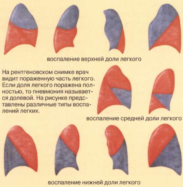 Очаговая пневмония у детей, взрослых. Симптомы, диагностика, клинические рекомендации