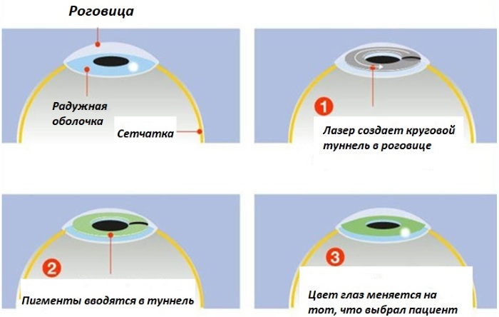 Операция по изменению цвета глаз лазером. Фото до и после, цена