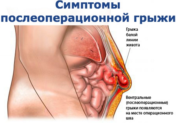 Послеоперационные осложнения в хирургии. Что это такое, ранние, поздние, классификация